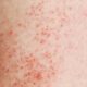 10 warning signs of mold toxicity