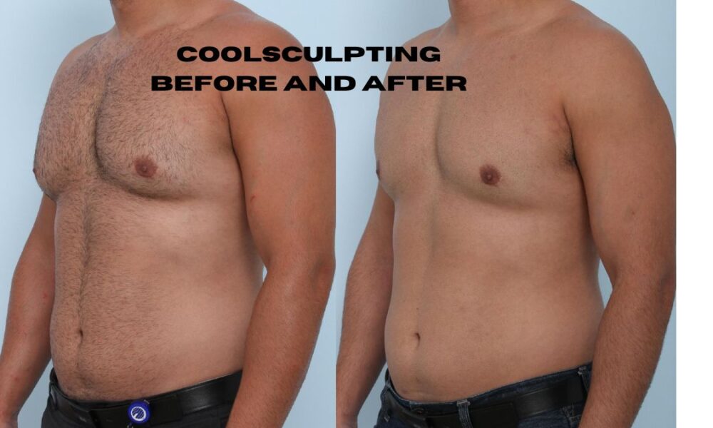 coolsculpting before and after