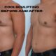coolsculpting before and after