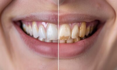 Dental Bonding Before and After