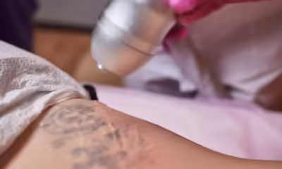 Tattoo Removal