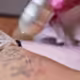 Tattoo Removal