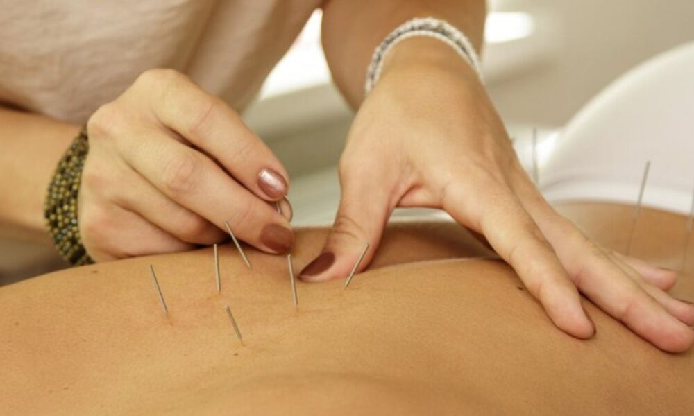 Acupuncture