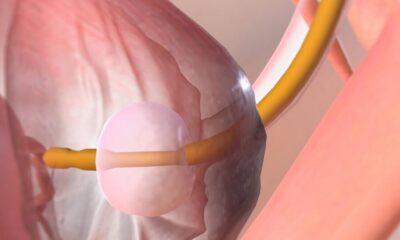 Knee Joint Replacement