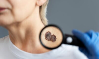 Mole Mapping in Melbourne
